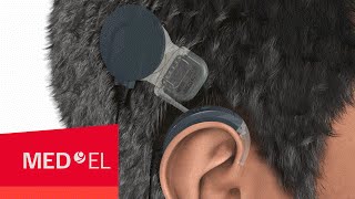 How Do Cochlear Implants Work The SYNCHRONY Cochlear Implant  MEDEL [upl. by Zeitler]