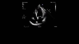 Echocardiography Study [upl. by Chladek879]