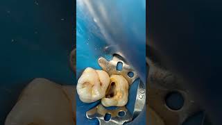 Molar 🦷 root canal treatment dentist dental dentalprocedure [upl. by Aynatahs]