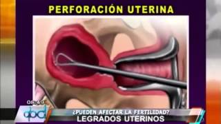 PROCREAR ¿Los legrados uterinos afectan la fertilidad [upl. by Sivrat]