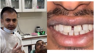 Mid line diastema  teeth gap closure दातों के बीच के गेप्स को भरना [upl. by Vadnee489]