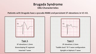 Advanced EKGs  Sudden Cardiac Death Hypertrophic cardiomyopathy ARVD Brugada syndrome and CPVT [upl. by Seta822]