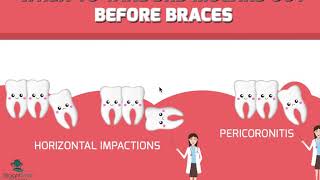 Should Wisdom Teeth  Third Molars 3rd be Removed before Braces [upl. by Helli]