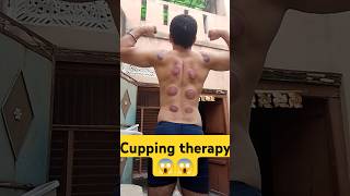 Cupping therapy benifits trending cupping cuppingtherapy hijama shorts youtubeshorts [upl. by Erfert]