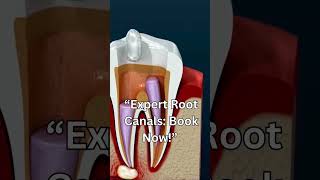 Get Relief Now Expert Root Canal Treatment at Partha Dental [upl. by Areval]