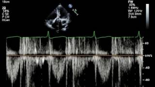 Echo Challenge Mitral Regurgitation [upl. by Hermann355]