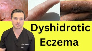 What is Dyshidrotic hand Eczema Causes and treatment [upl. by Coheman]