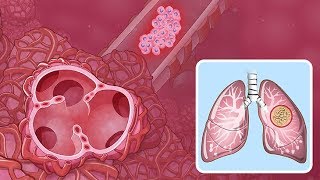 Understanding NonSmall Cell Lung Cancer [upl. by Onaicram]