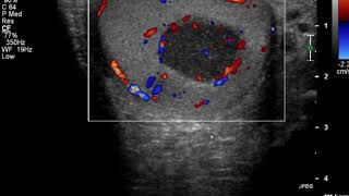 Ultrasound clues that indicate testicular lymphoma [upl. by Suicul]