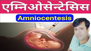 Amniocentesis  What is Amniocentesis in Hindi  प्रेगनेंसी में क्यों जरूरी है एम्‍न‍ियो टेस्ट [upl. by Naga974]