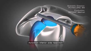 Shoulder Arthroscopy  Acromioplasty [upl. by Campos]