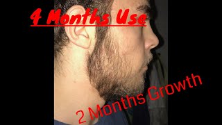 MINOXIDIL BEARD 2 month of GROWTH 4 months of use TIMELAPSE [upl. by Nnylrebma]