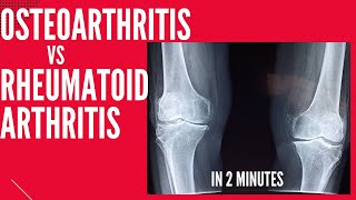 Osteoarthritis vs Rheumatoid arthritis in 2 mins [upl. by Kellene]