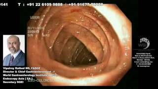 Endoscopic procedure for Angiodysplasia lesion [upl. by Maurits853]