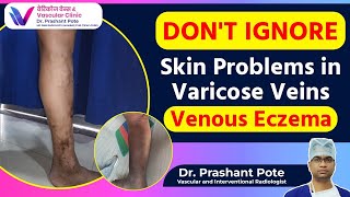 Dont Ignore These Symptoms Venous Eczema amp Varicose Veins Explained  Dr Prashant Pote [upl. by Aelc]