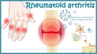 Rheumatoid Arthritis  autoimmune disorder  Pathophysiology risk factors treatment [upl. by Feldstein]