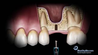 Basic Hammerless Sinus Lift Instrument Technique [upl. by Ahtiekal]