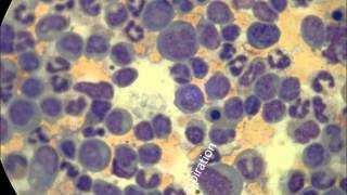 Juvenile Myelomonocytic leukemia 3 patients [upl. by Veats]