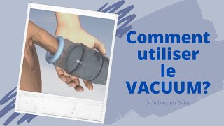 Dr Sébastien Beley Comment utiliser le vacuum [upl. by Nylg]