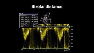 Echocardiography Essentials Assessing left ventricular global systolic function LVF [upl. by Tnecniv]