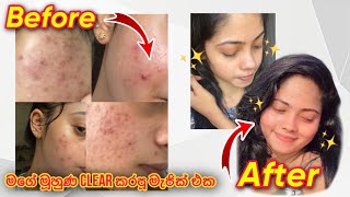 මාසෙකින් pimples නැති කරපු මැජික් එක 🧏🏻‍♀️✨ vlog skincare clearskin [upl. by Farleigh]