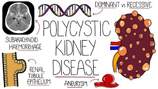 Polycystic Kidney Disease Explained [upl. by Bathsheeb]