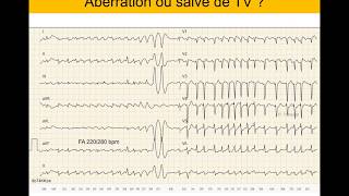 Tachycardie ventriculaire ou supraventriculaire  Quiz ECG Dr Taboulet [upl. by Sadella665]