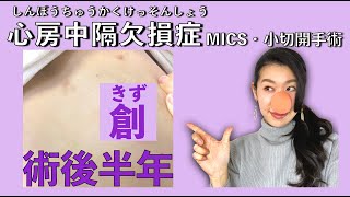 【心臓手術】心房中隔欠損症 術後半年の様子 小切開手術 MICS [upl. by Anivram147]