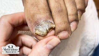 Tips to Treat Nail Fungus at Home [upl. by Isolt130]