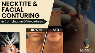 Neck Tightening with AccuTite l Facial Contouring l Accutite Procedure For Sagging Skin amp Wrinkles [upl. by Okime]