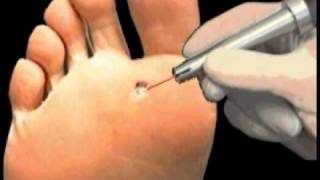 Plantar Wart Laser Treatment  Institute Beaute New York [upl. by Clementius]