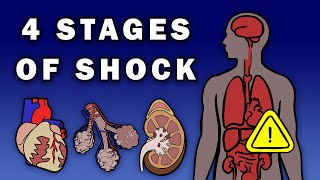 Shock  Hypovolemic Cardiogenic Obstructive Distributive  Retired [upl. by Releehw]