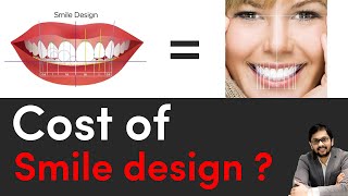 Cost of smile design   Dr Ankit khasgiwala  Seraphic dental clinic Indore [upl. by Guillaume546]