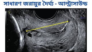 How to measure Cervical Length  Ultrasound Bangla [upl. by Stoffel]