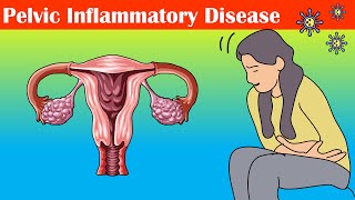 Pelvic Inflammatory Disease PID  Causes Signs amp Symptoms Diagnosis And Treatment [upl. by Leinnad]