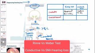 Conductive vs sensorineural hearing loss neurology 159 First Aid USMLE Step 1 in UrduHindi [upl. by Armat983]