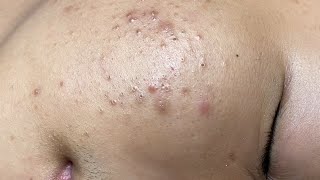 ACNE TREATMENT VU QUYNH MI Blackheads On Boy Face 2024 [upl. by Lebasi]