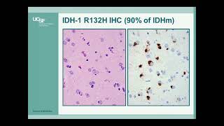 New Immunohistochemical Biomarkers in Surgical Neuropathology by Arie Perry MD [upl. by Notac759]