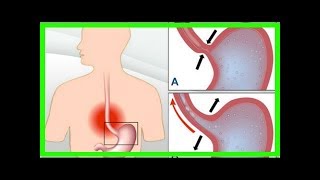 7 remèdes naturels pour soigner l’acidité et le reflux gastrique [upl. by Awhsoj]