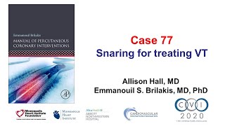 Case 77 PCI Manual  Snaring for treating ventricular tachycardia [upl. by Yddur]