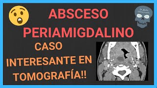 ABSCESO PERIAMIGDALINO tomografía💥 [upl. by Nileuqay370]