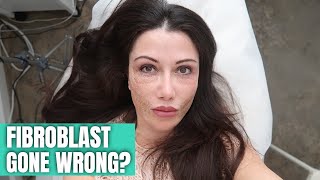 FIBROBLAST TREATMENT GONE WRONG [upl. by Anilatac]