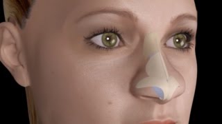 Bulbous Large Nasal Tip Nose Job Rhinoplasty [upl. by Rica]