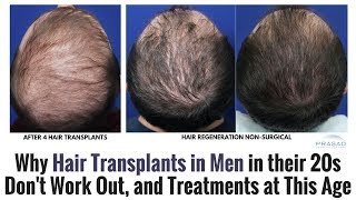 Why Hair Transplants for Men in Their 20s Dont Work Out and Restoration Treatments at This Age [upl. by Nojid]