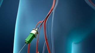 Coronary Angioplasty Femoral Access [upl. by Sisak]