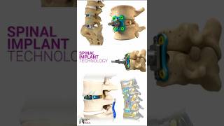 Surgical Device Medical Animation Prism Surgical  AQUILABOREALIS ACDF Spinal System 3d short [upl. by Ttcos51]