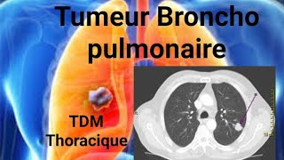 SCANNER THORACOABDOMINAL Tumeur bronchopulmonaire apicale [upl. by Halian]