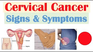 Cervical Cancer Signs amp Symptoms amp Why They Occur [upl. by Feliks275]