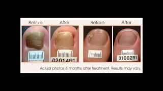 how to get rid of toenail fungus  how to get rid of toe fungus  toenail fungus treatment [upl. by Eisse]