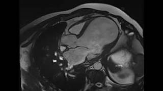 LV aneurysm on CINE SSFP cardiac MRI scan [upl. by Ylil]